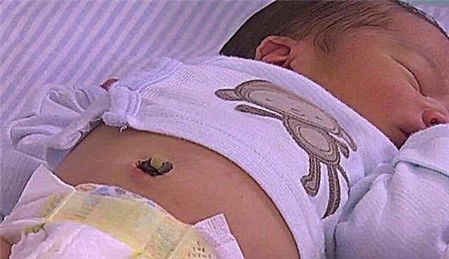 7 إجراءات فورية من طبيب الأطفال حديثي الولادة إذا كان زر بطن المولود ينزف