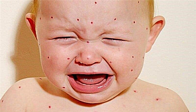 7 popular questions about rubella in children. Specialist answers