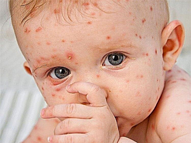 What is chickenpox and how is it treated in children?