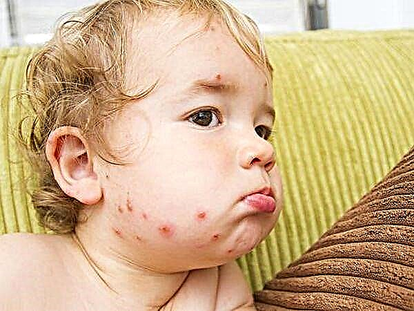Prevención de la varicela