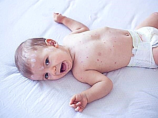 Colorless chickenpox remedies