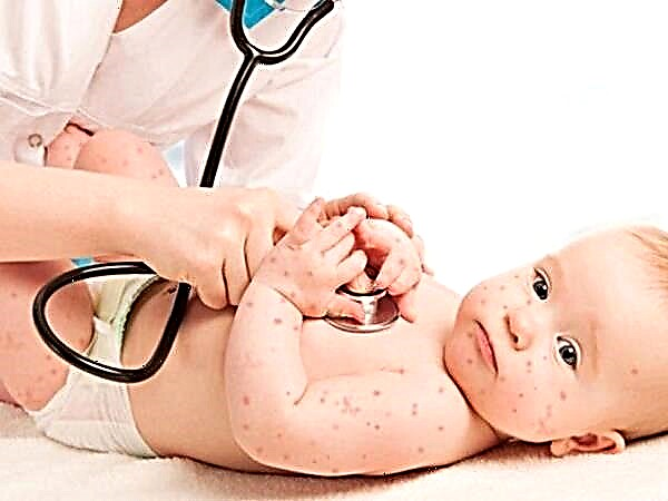 Posibles complicaciones después de la varicela en niños.