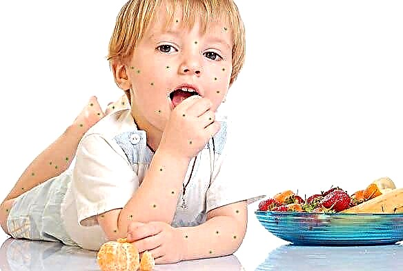 Kost hos barn med vattkoppor