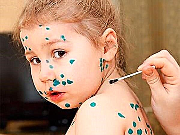 Simptome, semne și tratament al varicelei la copii