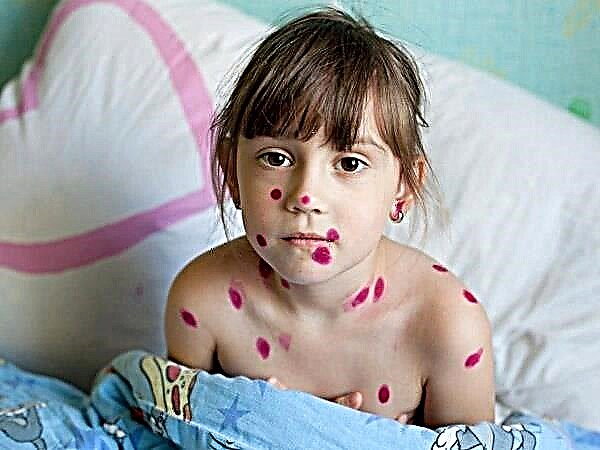 Is it possible for a child to walk with chickenpox