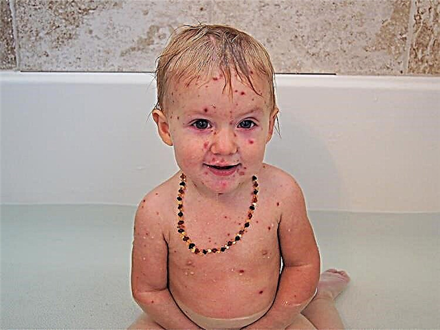 Is it possible to bathe a child with chickenpox?
