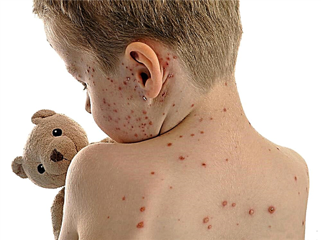 The incubation period of chickenpox