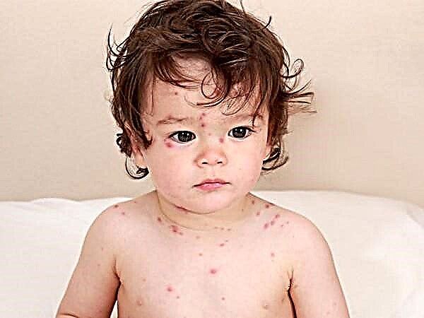 What chickenpox looks like: compare the rash with the one in the photo