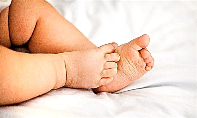 Clubfoot in children: from symptoms to treatment. What forms can be corrected at home?