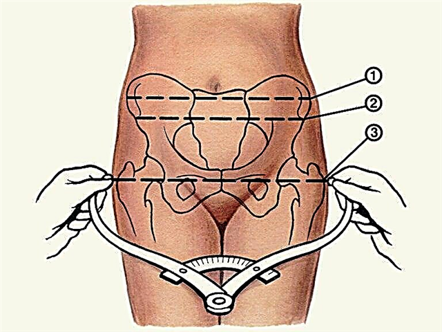Uska zdjelica tijekom trudnoće i njezin klinički oblik