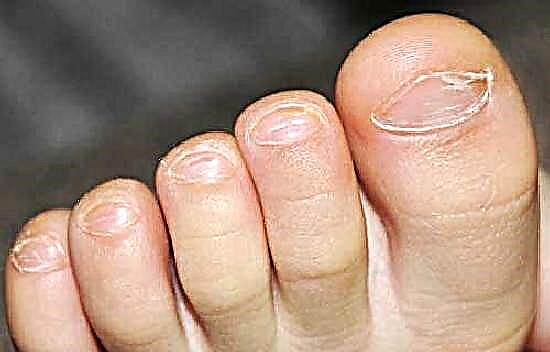 ¿Qué hacer si las uñas de los pies de su hijo se están pelando o rotas?