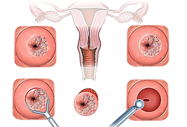 Erosão do colo do útero após o parto