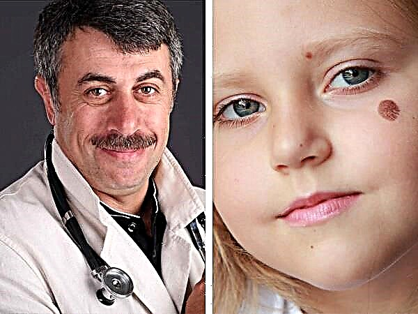 Bác sĩ Komarovsky về vết bớt ở trẻ em