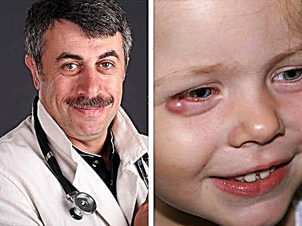 الدكتور كوماروفسكي يتحدث عن كيفية معالجة الشعير في عين الطفل