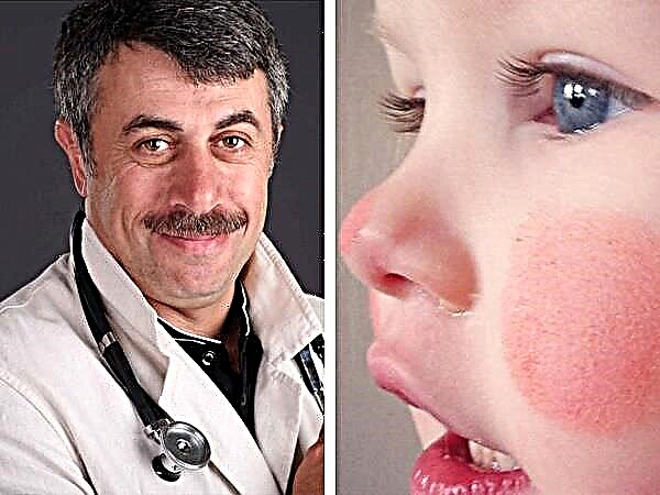 Lääkäri Komarovsky punaisista poskista lapsessa