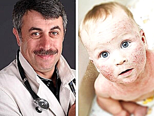 Dr. Komarovsky o zdravljenju atopijskega dermatitisa pri otrocih