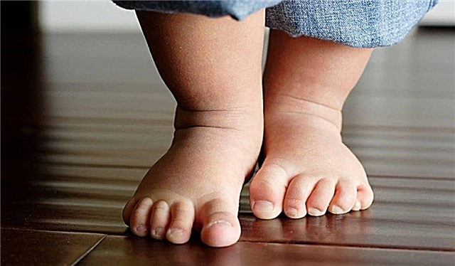 تمارين لإبهام القدم الأروح عند الأطفال