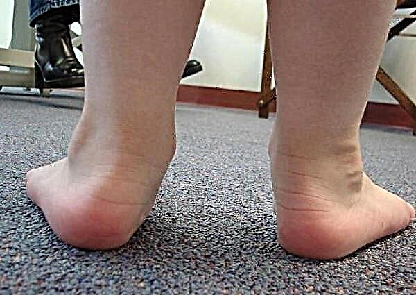 Varus deformity of the foot in children