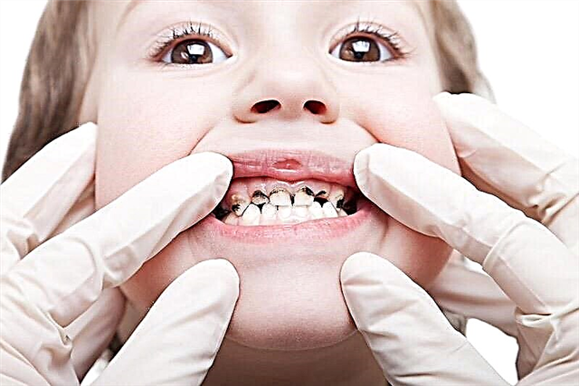 تسوس الأسنان اللبنية عند الطفل
