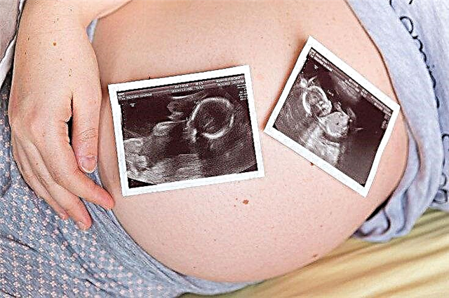 Banyak kehamilan dengan IVF: dari kebarangkalian hingga risiko