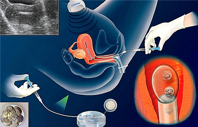 Mengapa implantasi embrio selepas IVF tidak selalu berlaku? Sebab dan simptom