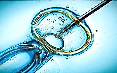Kas yra ICSI - intracitoplazminė spermos injekcija, kaip vyksta procedūra?
