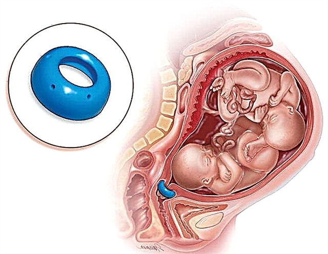 Características do parto após a remoção do pessário