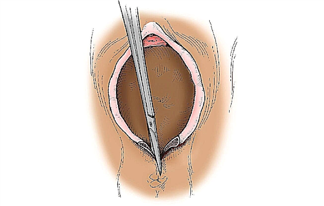What is perineotomy and when is it used during childbirth?
