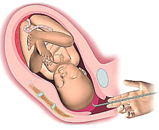 Vad är fostervatten under förlossningen och varför punkteras blåsan?