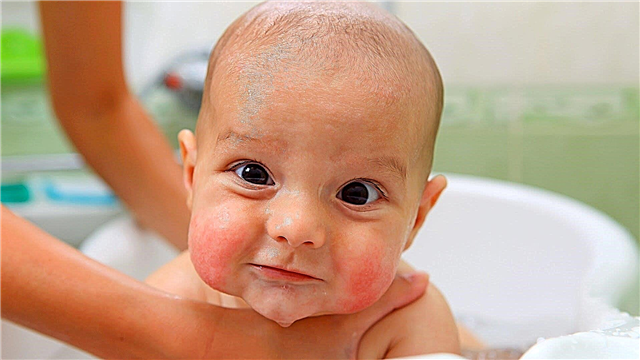 Atopická dermatitida u kojenců