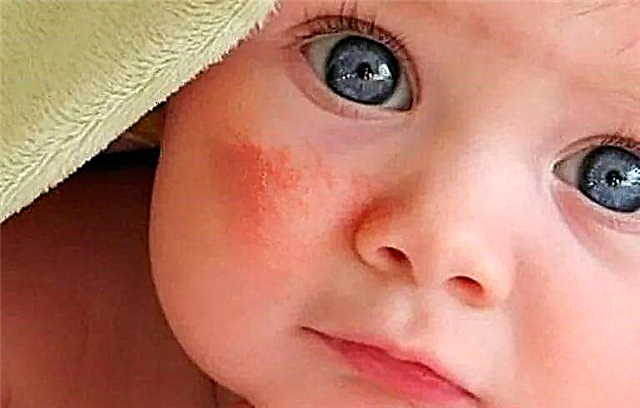 What does dermatitis look like in children?