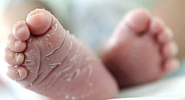 Was tun, wenn sich die Haut eines Neugeborenen abschält?