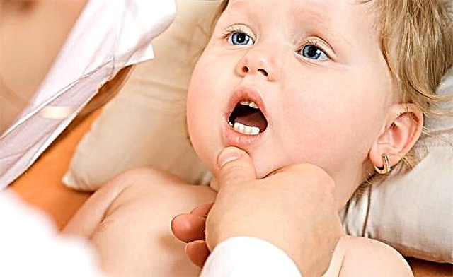 Thrush in a child after taking antibiotics