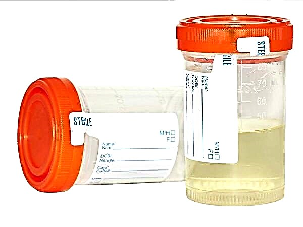 Analisis urin pada anak-anak menurut Sulkovich