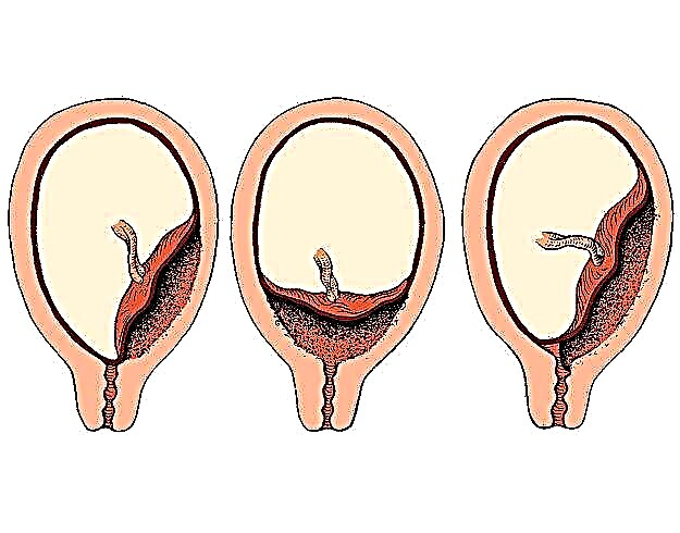 Mis on platsenta previa ja kuidas see mõjutab rasedust ja sünnitust?