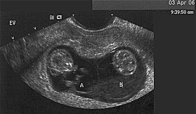 Što je CTE fetusa i kako bi trebao biti normalan tijekom trudnoće?
