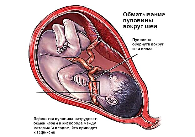 Je nebezpečné proplést pupeční šňůru kolem krku plodu a jak to ovlivňuje porod?
