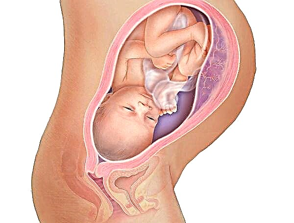 गर्भाशय की पूर्वकाल की दीवार पर प्लेसेंटा प्रिविया का क्या अर्थ है और यह क्या प्रभावित करता है?
