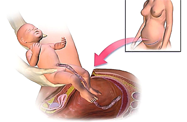 All About Caesarean Section