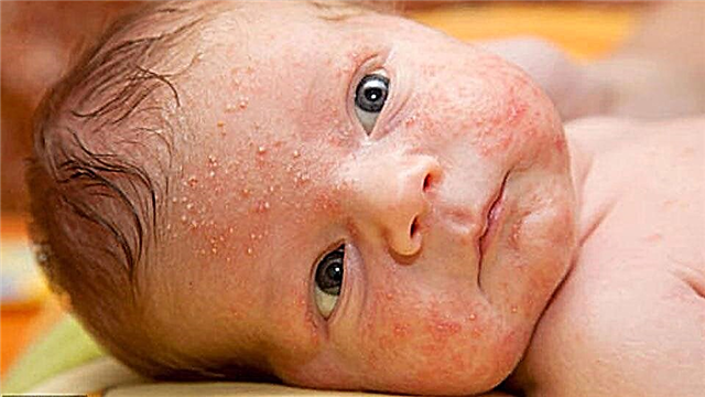 Yenidoğanlarda ve bebeklerde dikenli ısının semptomları ve tedavisi