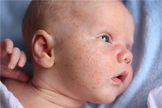 Stickig värme i ansiktet på en baby