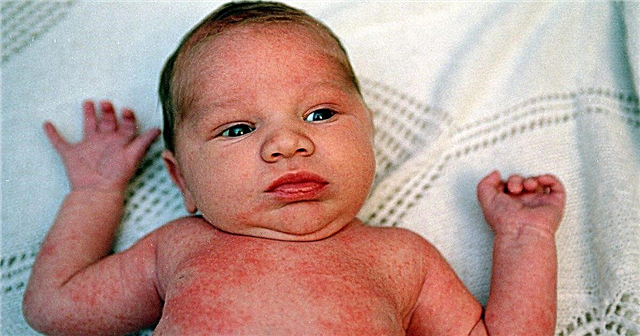 Kako je videti bodičasto vročino pri otrocih?
