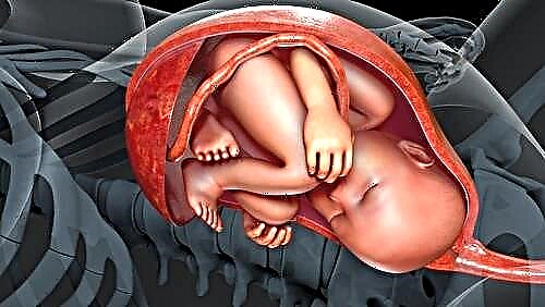Types de fixation du cordon ombilical au placenta: normes et risque de déviations