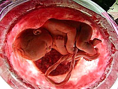 Vôi hóa nhau thai có nghĩa là gì và nó xảy ra dưới những hình thức nào?