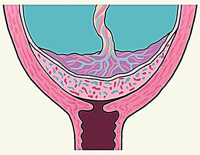 Какво означава пълно предлежание на плацентата и защо е опасно по време на бременност?