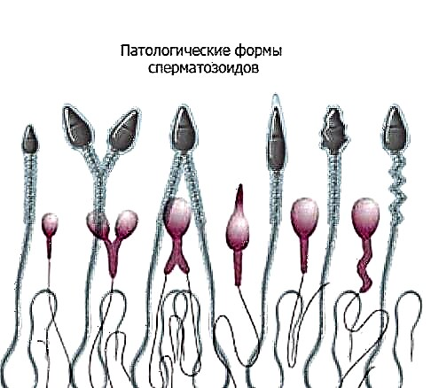 Kokios yra spermatozoidų patologinės formos ir kaip jos veikia pastojimo sėkmę?