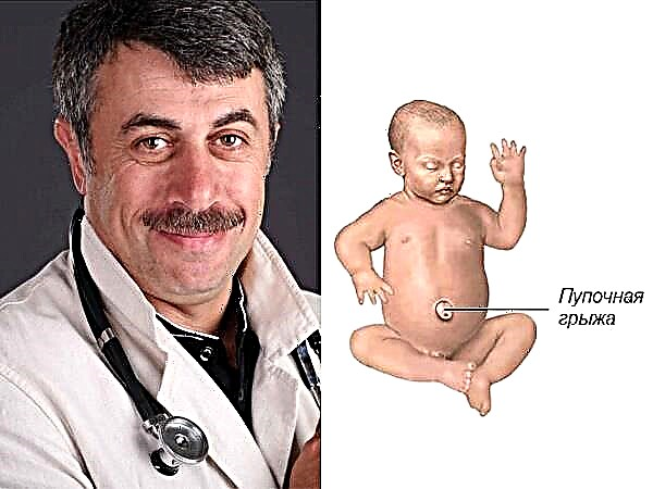 Dr. Komarovsky sobre la hernia umbilical en recién nacidos y niños pequeños
