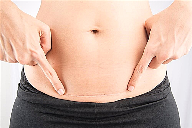 Χαρακτηριστικά της εγκυμοσύνης μετά από καισαρική τομή