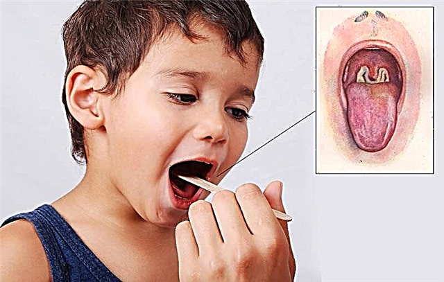 Síntomas, tratamiento y prevención de la difteria en niños.