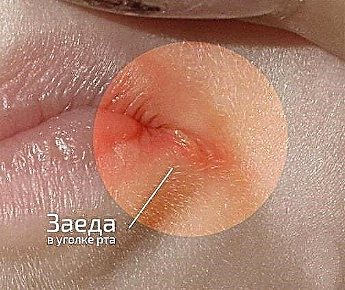 التهاب الأنف في زوايا الفم عند الأطفال